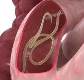 Les ascaris sont assez courants dans l’intestin humain. 