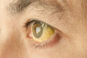 jaunissement du blanc des yeux